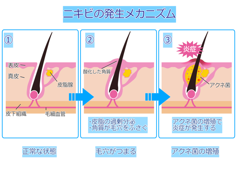 ニキビのメカニズム図